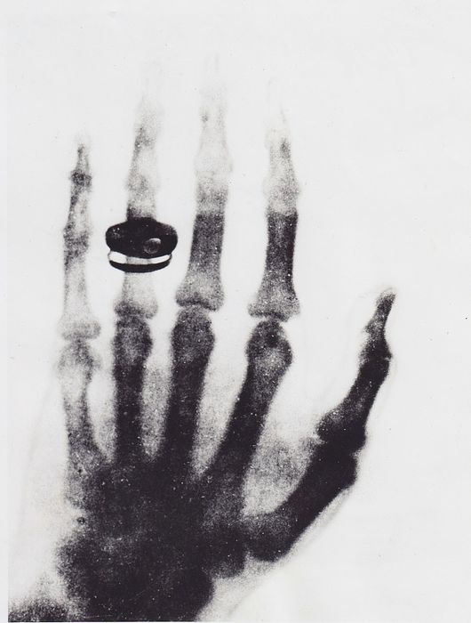 أول صورة في العالم بأشعة x ليد زوجة وليام رونتجن