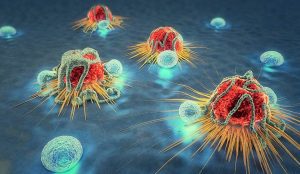 سرطان الرئة- الخلايا غير المتمايزة