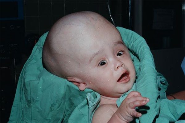 https://www.ispn.guide/hydrocephalus-and-other-anomalies-of-csf-circulation-in-children/||