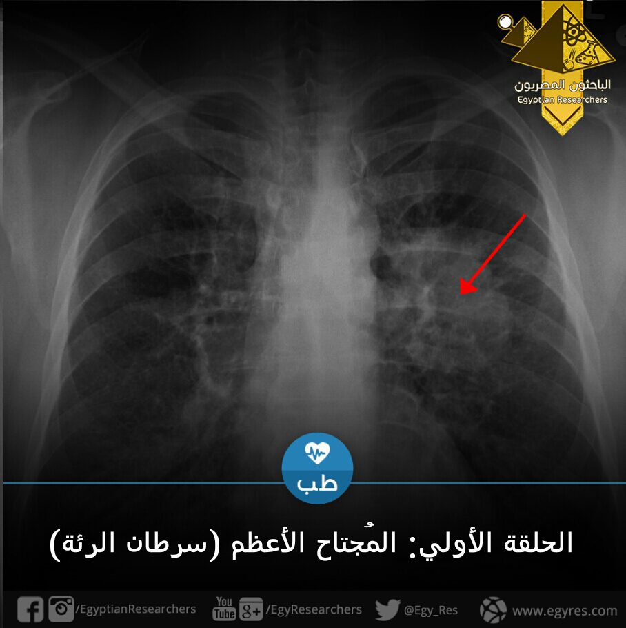 سرطان الرئة الباحثون المصريون