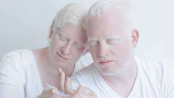 صورة (3): يعني المهق فقدان لأغلب كميات الميلانين في الجسم، فيصبح الجسم والشعر كاملا باللون الأبيض أو الأصفر. 
المصدر:
https://m.dailyhunt.in/news/india/english/healthhunt-epaper-healthun/international+albinism+awareness+day+symptoms+causes+and+diagnosis+of+albinism-newsid-120114758