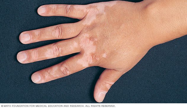 https://www.mayoclinic.org/diseases-conditions/vitiligo/symptoms-causes/syc-20355912||||