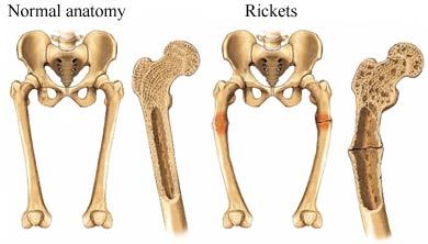 شكل القدمين في حالة مرض ال ” Rickets” مقارنة بالشكل الطبيعي
