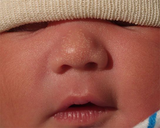 الدخينات على أنف طفل حديث الولادة
